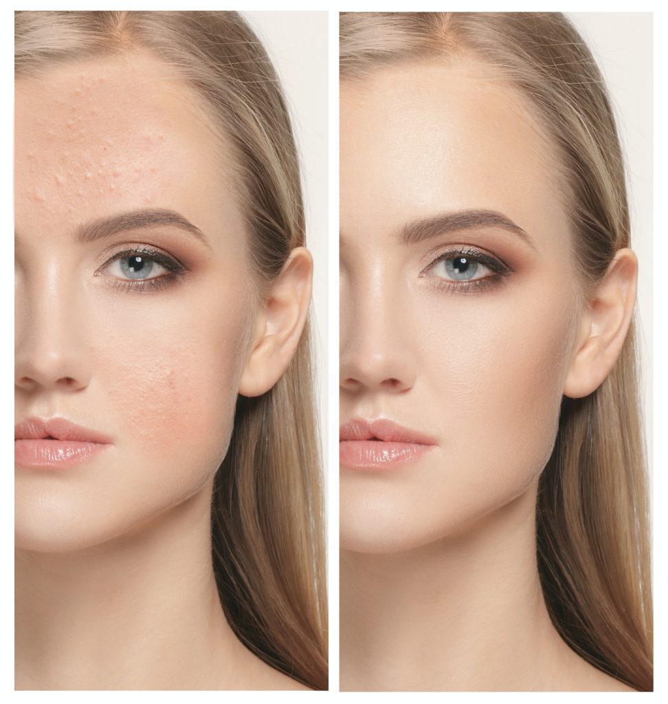 Woman before and after treatment